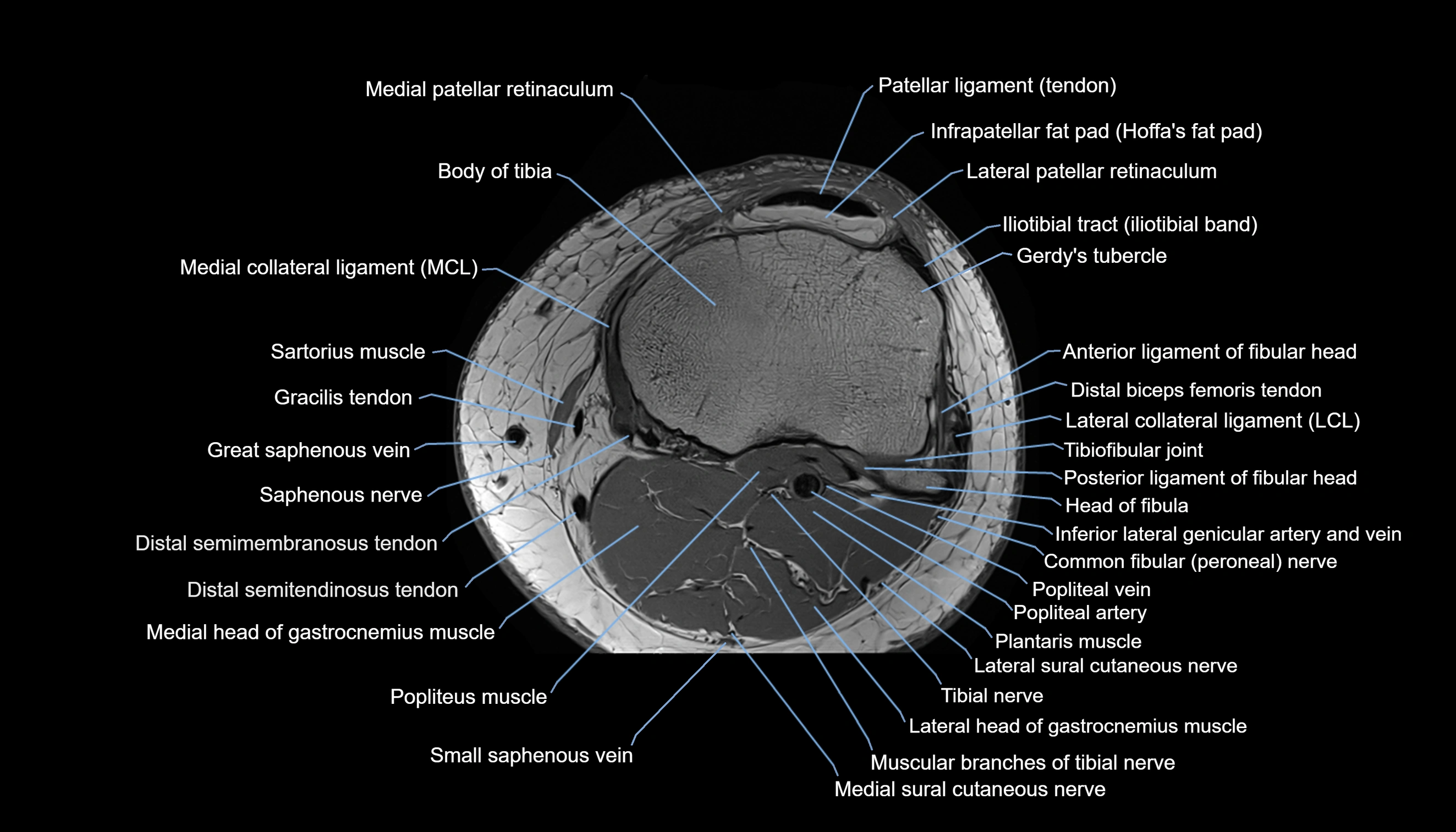 MRI knee  axial cross sectional anatomy 3T radiology  image-img-00001-00037.webp